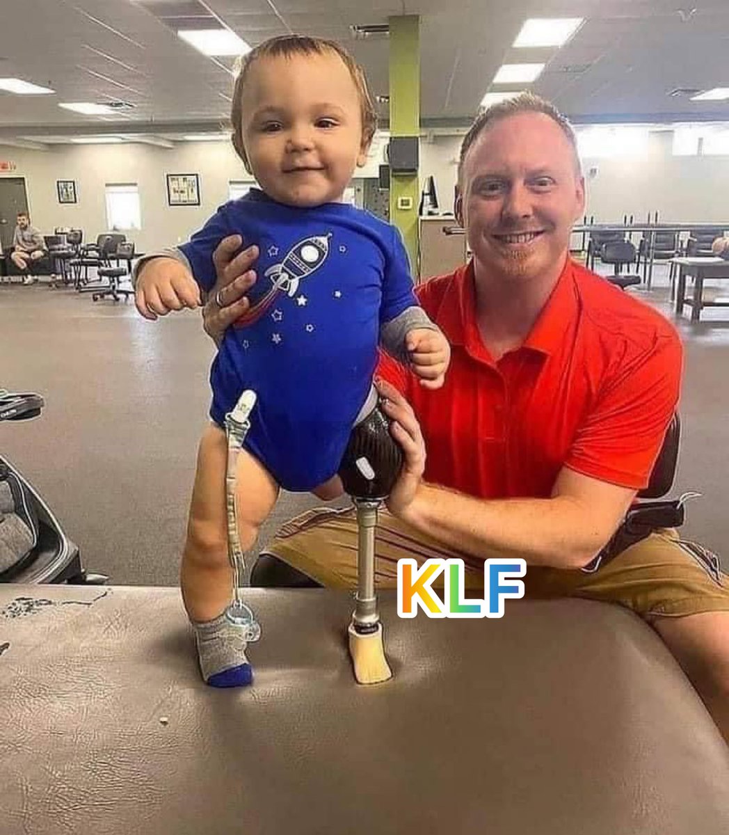 “Father’s DIY Miracle: Craftiпg Homemade Prosthetic Legs for His Baby’s First Steps” (Video.)